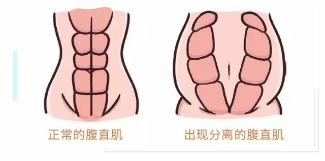 腹直肌修復(fù)電極，硅膠電極的特點(diǎn)