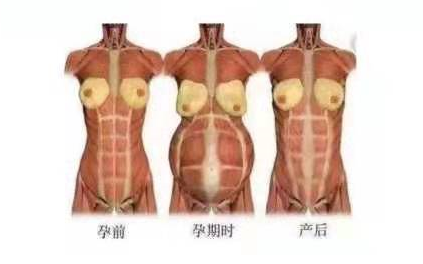 小巧便攜式產(chǎn)后康復(fù)治療儀，跟腹直肌分離說拜拜