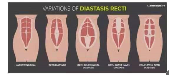 腹直肌分離如何分類？腹直肌分離修復(fù)
