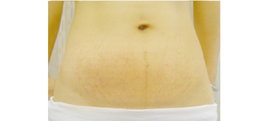 盆底肌修復(fù)儀器對于產(chǎn)后康復(fù)治療常見的幾大問題