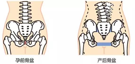 腹直肌分離怎么恢復(fù)，大概多少錢？