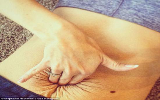 1563517913637102.png 腹直肌分離