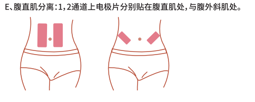 1563865997352285.png 腹直肌修復(fù)