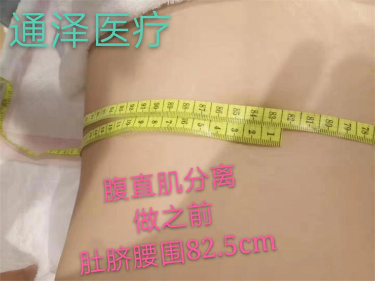 1563866555537174.png 腹直肌分離