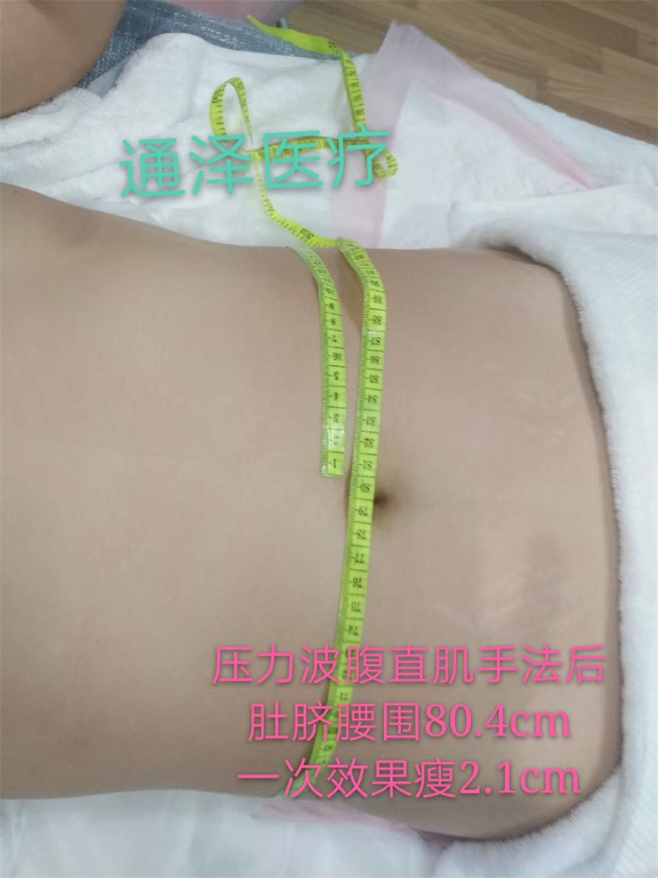 1563866563320834.png 腹直肌修復(fù)