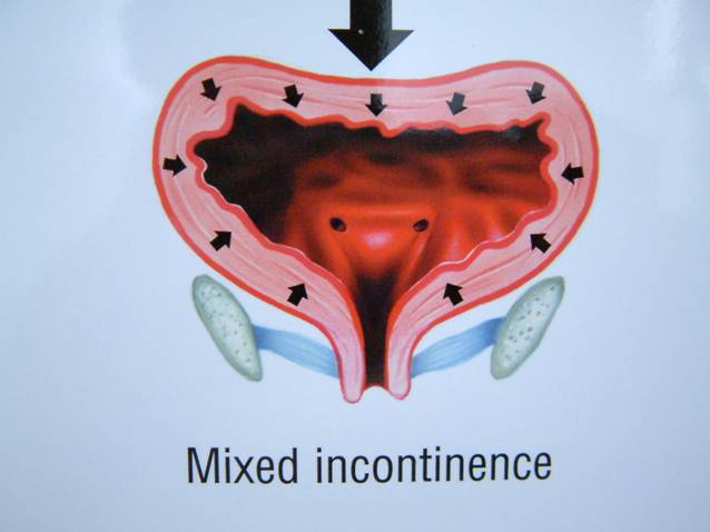 1568947596828508.png 盆底肌治療