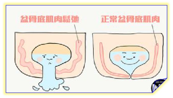 產(chǎn)后盆底康復(fù)