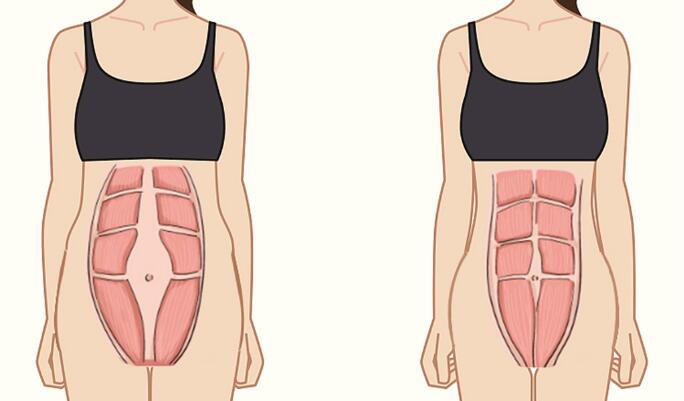 1573632787808110.jpg 腹直肌分離