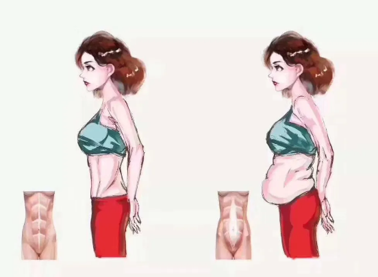 1582851859502310.png 腹直肌修復