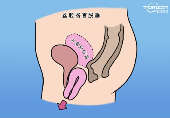 盆底肌修復儀器 盆底肌修復儀器