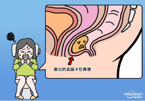 盆底肌修復(fù)儀器 盆底肌修復(fù)儀器